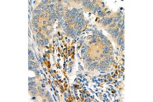 Immunohistochemistry of paraffin embedded human colon cancer using P4H (ABIN7074215) at dilution of 1:700 (400x lens) (HIF Prolyl Hydroxylase Antikörper)