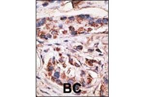 Formalin-fixed and paraffin-embedded human cancer tissue reacted with the primary antibody, which was peroxidase-conjugated to the secondary antibody, followed by DAB staining. (MAGEA1 Antikörper  (AA 143-173))