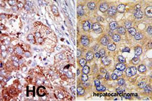 Formalin-fixed and paraffin-embedded human hepatocellular carcinoma tissue reacted with PFKFB4 polyclonal antibody  , which was peroxidase-conjugated to the secondary antibody, followed by AEC staining.