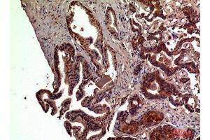 Immunohistochemistry (IHC) analysis of paraffin-embedded Human Prostate Cancer, antibody was diluted at 1:100. (RSAD2 Antikörper  (Internal Region))