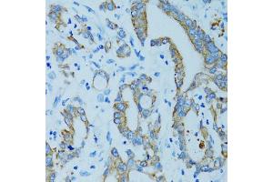 Immunohistochemistry of paraffin-embedded human colon carcinoma using KRT15 antibody (ABIN5971439) at dilution of 1/100 (40x lens). (KRT15 Antikörper)