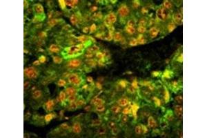 Immunofluorescence analysis of CD38 antibody with paraffin-embedded human hepatocarcinoma tissue. (CD38 Antikörper  (AA 241-270))