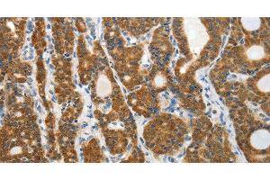 Immunohistochemistry of paraffin-embedded Human thyroid cancer tissue using PRDX5 Polyclonal Antibody at dilution 1:40 (Peroxiredoxin 5 Antikörper)