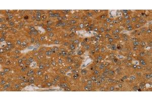 Immunohistochemistry of paraffin-embedded Human liver cancer tissue using PARP3 Polyclonal Antibody at dilution 1:40 (PARP3 Antikörper)