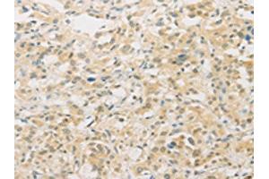 The image on the left is immunohistochemistry of paraffin-embedded Human thyroid cancer tissue using ABIN7129533(FNTA Antibody) at dilution 1/30, on the right is treated with fusion protein.