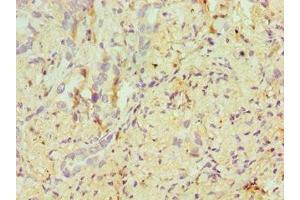 Immunohistochemistry of paraffin-embedded human lung cancer using ABIN7171955 at dilution of 1:100 (ERCC2 Antikörper  (AA 1-300))