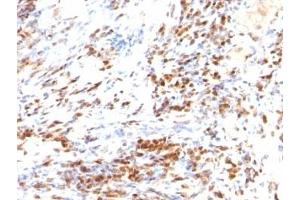 Formalin-fixed, paraffin-embedded human colon carcinoma stained with p27 antibody (DCS-72. (P27 Antikörper)
