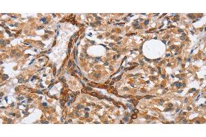 Immunohistochemistry of paraffin-embedded Human thyroid cancer tissue using BUB1 Polyclonal Antibody at dilution 1:50 (BUB1 Antikörper)