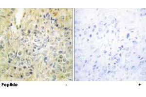Immunohistochemistry analysis of paraffin-embedded human prostate carcinoma tissue, using DLEC1 polyclonal antibody . (DLEC1 Antikörper  (N-Term))