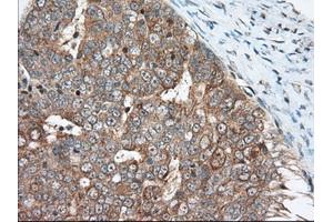 Immunohistochemical staining of paraffin-embedded Adenocarcinoma of Human breast tissue using anti-MIOX mouse monoclonal antibody. (MIOX Antikörper)