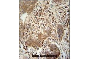 TAG antibody (Center) 10962c immunohistochemistry analysis in formalin fixed and paraffin embedded human lung carcinoma followed by peroxidase conjugation of the secondary antibody and DAB staining. (TAGAP Antikörper  (AA 103-129))
