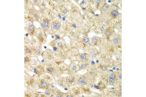 Immunohistochemistry of paraffin-embedded human liver injury using CALD1 antibody (ABIN5973102) at dilution of 1/100 (40x lens). (Caldesmon Antikörper)