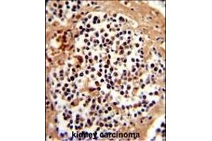 Formalin-fixed and paraffin-embedded human kidney carcinoma reacted with SERPINB7 Antibody (Center), which was peroxidase-conjugated to the secondary antibody, followed by DAB staining. (SERPINB7 Antikörper  (AA 108-137))