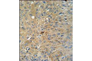 Cleaved-CASP3 (Asp175)Antibody (ABIN650861 and ABIN2839812) IHC analysis in formalin fixed and paraffin embedded human lung carcinoma followed by peroxidase conjugation of the secondary antibody and DAB staining. (Caspase 3 Antikörper  (Cleaved-Asp175))