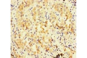 Immunohistochemistry of paraffin-embedded human lung cancer using ABIN7152480 at dilution of 1:100 (FBXL21 Antikörper  (AA 78-137))