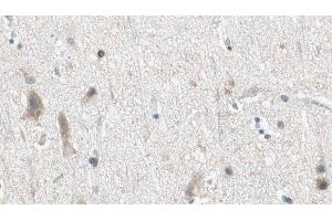 ABIN6275086 at 1/100 staining Human brain cancer tissue by IHC-P. (DZIP3 Antikörper  (Internal Region))