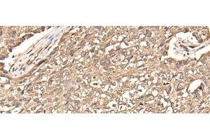 Immunohistochemistry of paraffin-embedded Human lung cancer tissue using USP21 Polyclonal Antibody at dilution of 1:50(x200) (USP21 Antikörper)