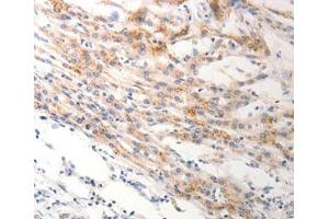 Immunohistochemical analysis of paraffin-embedded Human lung cancer tissue using at dilution 1/0. (Keratin 6B Antikörper  (Internal Region))
