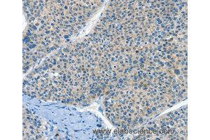 Immunohistochemistry of Human liver cancer using HID1 Polyclonal Antibody at dilution of 1:50 (HID1/DMC1 Antikörper)