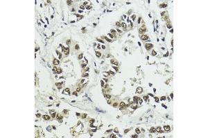 Immunohistochemistry of paraffin-embedded human lung cancer using Phospho-Histone H3-S10/T11 antibody (ABIN7267688) at dilution of 1:100 (40x lens).