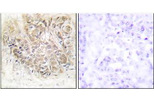 Immunohistochemistry analysis of paraffin-embedded human breast carcinoma tissue using TCTP antibody. (TPT1 Antikörper)