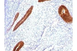 Formalin-fixed, paraffin-embedded human endometrial carcinoma stained with Cytokeratin 7 antibody (KRT7/760) (Cytokeratin 7 Antikörper)