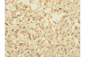 Immunohistochemistry of paraffin-embedded human melanoma using ABIN7148072 at dilution of 1:100 (CCDC113 Antikörper  (AA 1-200))