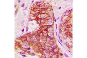 Immunohistochemical analysis of Connexin 43 staining in human breast cancer formalin fixed paraffin embedded tissue section. (Connexin 43/GJA1 Antikörper  (C-Term))
