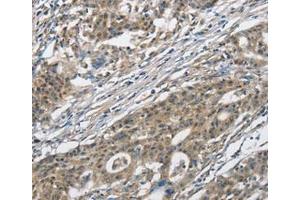 Immunohistochemical analysis of paraffin-embedded Human gastric cancer tissue using at dilution 1/30. (CACNA2D1 Antikörper  (Internal Region))