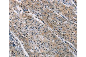 Immunohistochemistry of Human gastric cancer using BMP15 Polyclonal Antibody at dilution of 1:40 (BMP15 Antikörper)