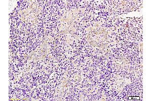 Formalin-fixed and paraffin embedded human glioma tissue labeled with Anti-JUP/Cateninma ? (JUP Antikörper  (AA 601-700))