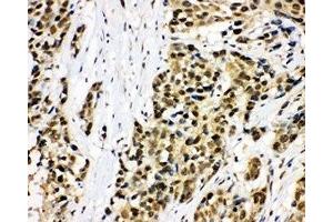IHC-P: MCM7 antibody testing of human lung cancer tissue (MCM7 Antikörper  (C-Term))
