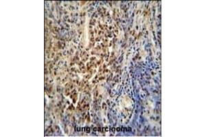PUS3 antibody (N-term) (ABIN654789 and ABIN2844467) immunohistochemistry analysis in formalin fixed and paraffin embedded human lung carcinoma followed by peroxidase conjugation of the secondary antibody and DAB staining. (PUS3 Antikörper  (N-Term))