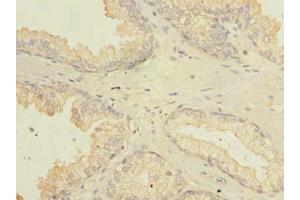 Immunohistochemistry of paraffin-embedded human prostate cancer using ABIN7165578 at dilution of 1:100 (Family with Sequence Similarity 92, Member A (FAM92A) (AA 1-271) Antikörper)
