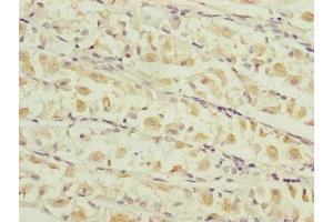 Immunohistochemistry of paraffin-embedded human gastric cancer using ABIN7159903 at dilution of 1:100 (TIMM17B Antikörper  (AA 1-172))
