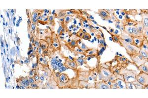 Immunohistochemistry of paraffin-embedded Human cervical cancer using Claudin 1 Polyclonal Antibody at dilution of 1:150 (Claudin 1 Antikörper)