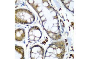 Immunohistochemistry of paraffin-embedded human colon carcinoma using SECISBP2 antibody at dilution of 1:200 (40x lens).