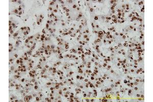Immunoperoxidase of monoclonal antibody to HMGB1 on formalin-fixed paraffin-embedded human hepatocellular carcinoma tissue. (HMGB1 Antikörper  (AA 1-215))