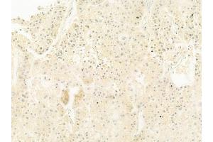 ABIN6261829 and ABIN6278464 at 1/100 staining human hepatocellular carcinoma by IHC-P.
