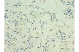Immunohistochemistry of paraffin-embedded human breast cancer using ABIN7155309 at dilution of 1:100 (HDAC11 Antikörper  (AA 1-347))