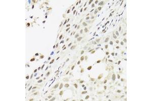 Immunohistochemistry of paraffin-embedded human lung cancer using C14orf166 antibody. (C14orf166 Antikörper)