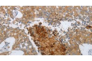 Immunohistochemistry of paraffin-embedded Human breast cancer using NGFR Polyclonal Antibody at dilution of 1:50 (NGFR Antikörper)