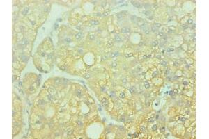 Immunohistochemical of paraffin-embedded human liver cancer using ABIN7143609 at dilution of 1:200 (Fetuin A Antikörper)