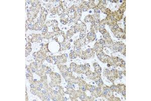 Immunohistochemistry of paraffin-embedded human liver injury using TSG101 antibody. (TSG101 Antikörper)