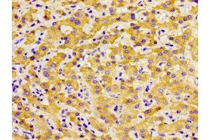 Immunohistochemistry of paraffin-embedded human liver cancer using ABIN7172602 at dilution of 1:100 (SOX11 Antikörper  (AA 241-341))