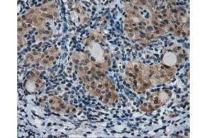 Immunohistochemical staining of paraffin-embedded Adenocarcinoma of colon tissue using anti-PTPRE mouse monoclonal antibody. (PTPRE Antikörper)