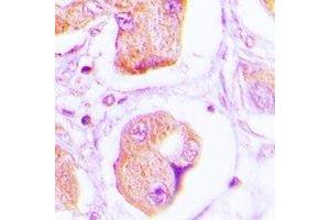 Immunohistochemical analysis of OLFM1 staining in human lung cancer formalin fixed paraffin embedded tissue section. (Olfactomedin 1 Antikörper)