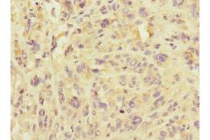 Immunohistochemistry of paraffin-embedded human melanoma using ABIN7159921 at dilution of 1:100 (IMMP2L Antikörper  (AA 1-100))