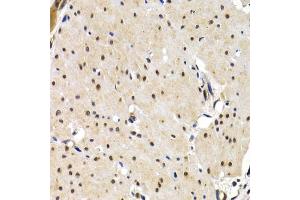 Immunohistochemistry of paraffin-embedded human gastric cancer using IRF2 antibody (ABIN3023366, ABIN3023367, ABIN3023368 and ABIN6219659) at dilution of 1:200 (40x lens). (IRF2 Antikörper  (AA 120-349))
