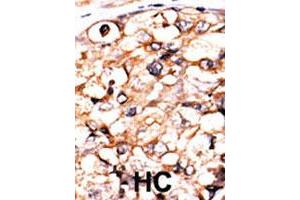 Formalin-fixed and paraffin-embedded human hepatocellular carcinoma tissue reacted with PGK2 polyclonal antibody  , which was peroxidase-conjugated to the secondary antibody, followed by AEC staining. (PGK2 Antikörper  (N-Term))